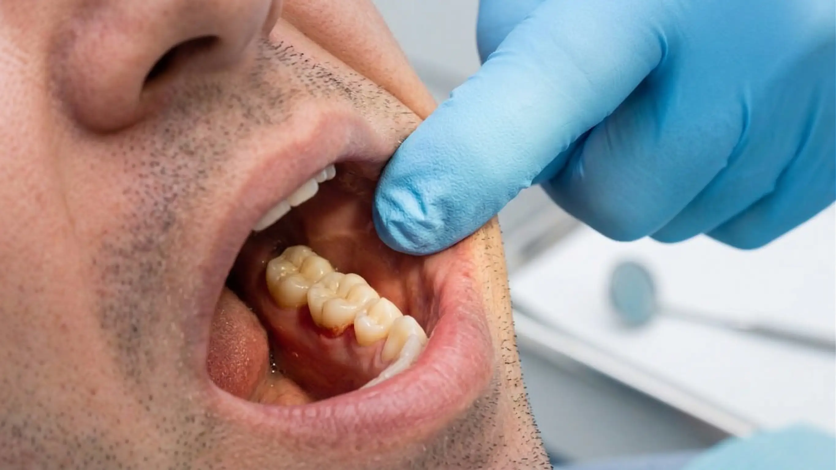 Is Teeth Replacement Painful? A Complete Guide for First-Time Patients