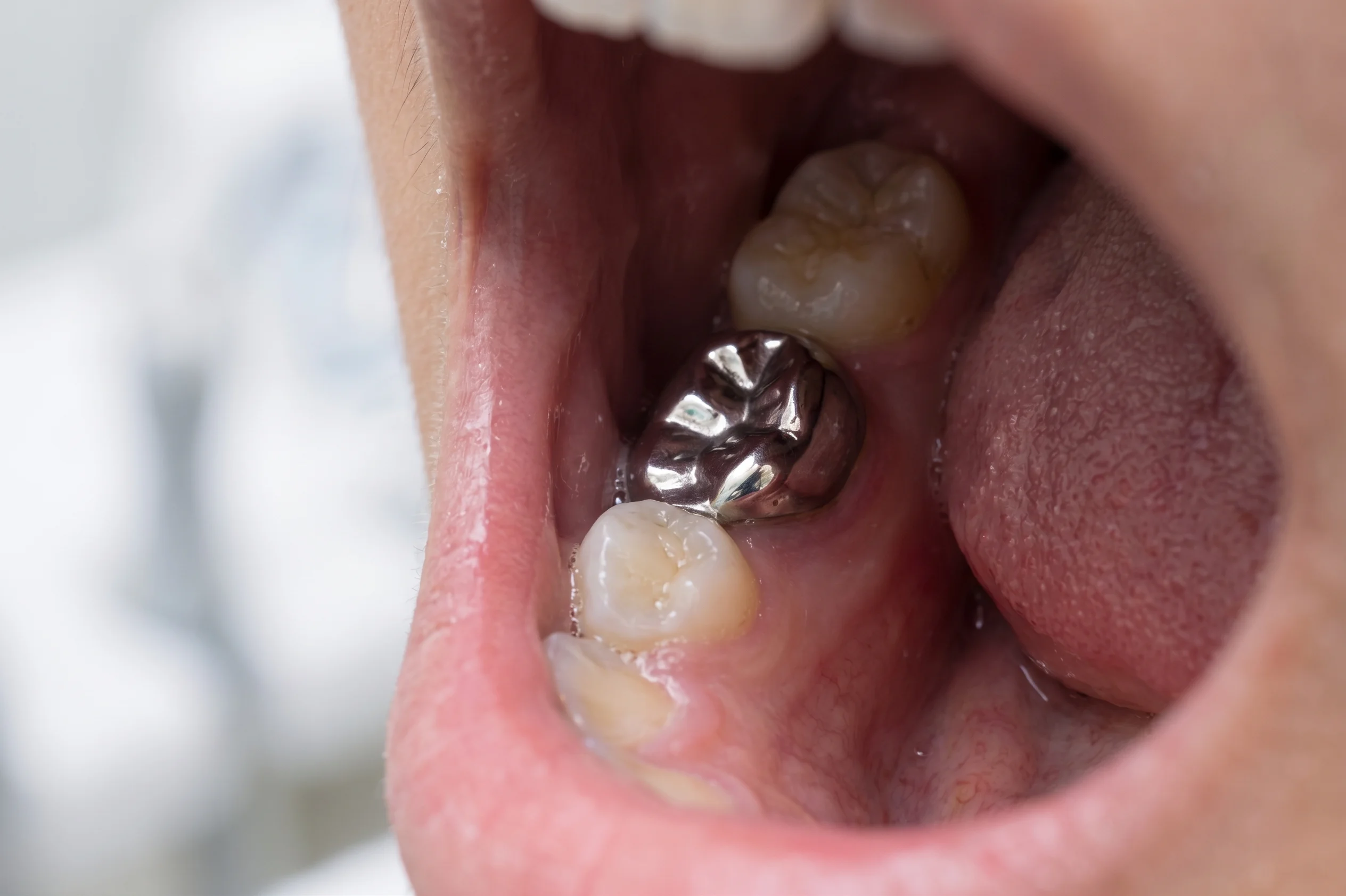 Metal Crowns
