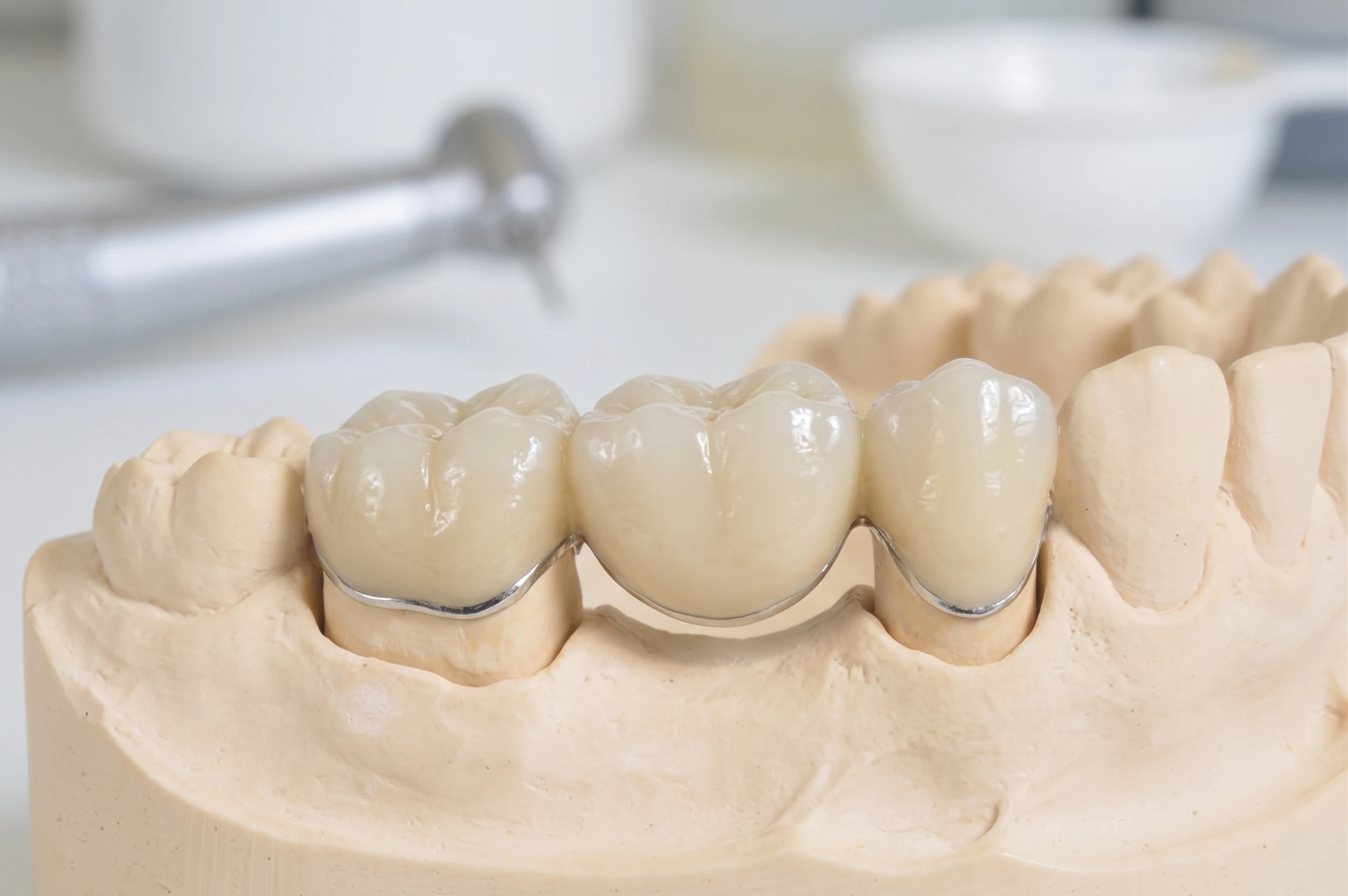 Porcelain-Fused-to-Metal (PFM) Crowns