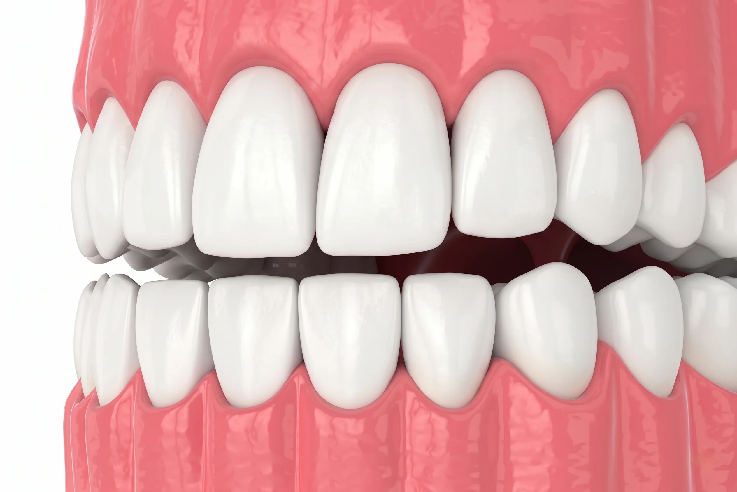 Ceramic Veneers
