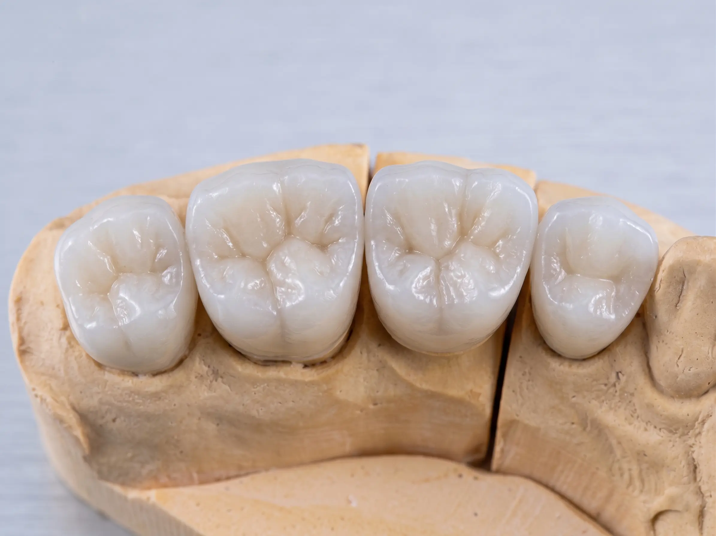 Emax Crowns