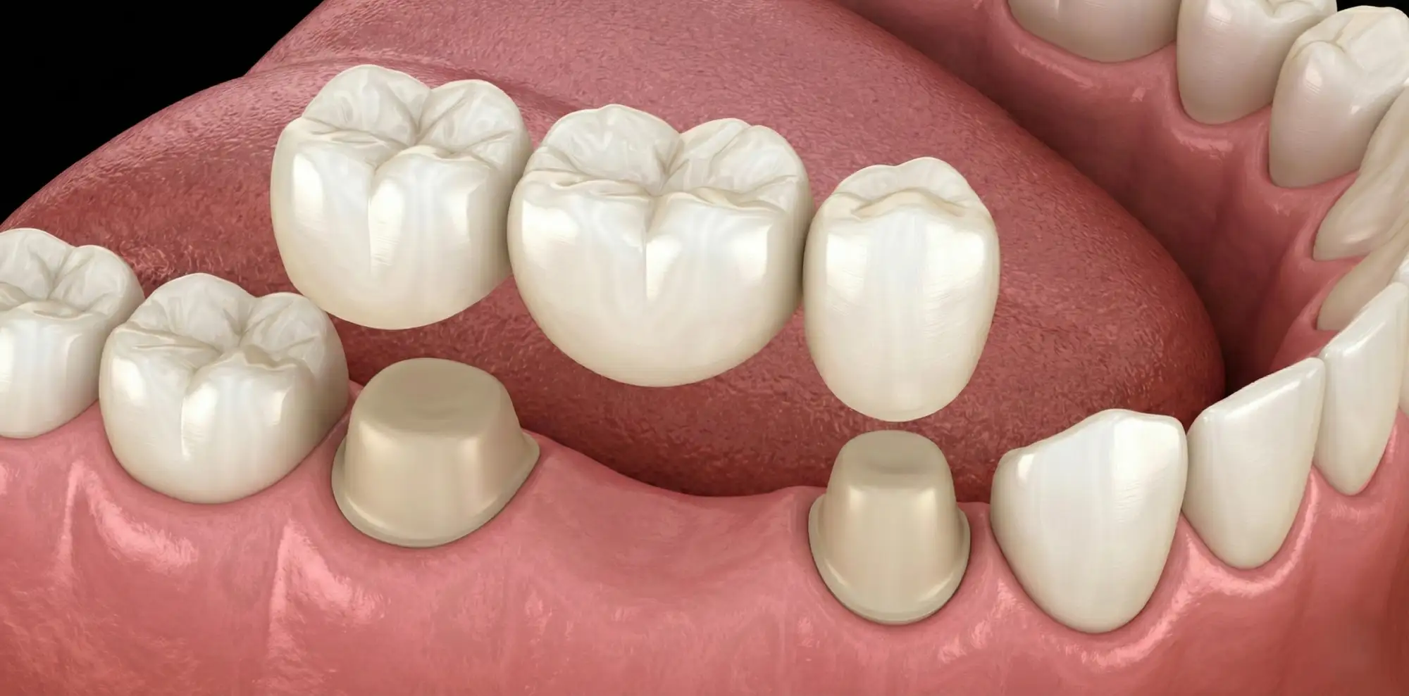 Fixed Partial Dentures (Bridge)