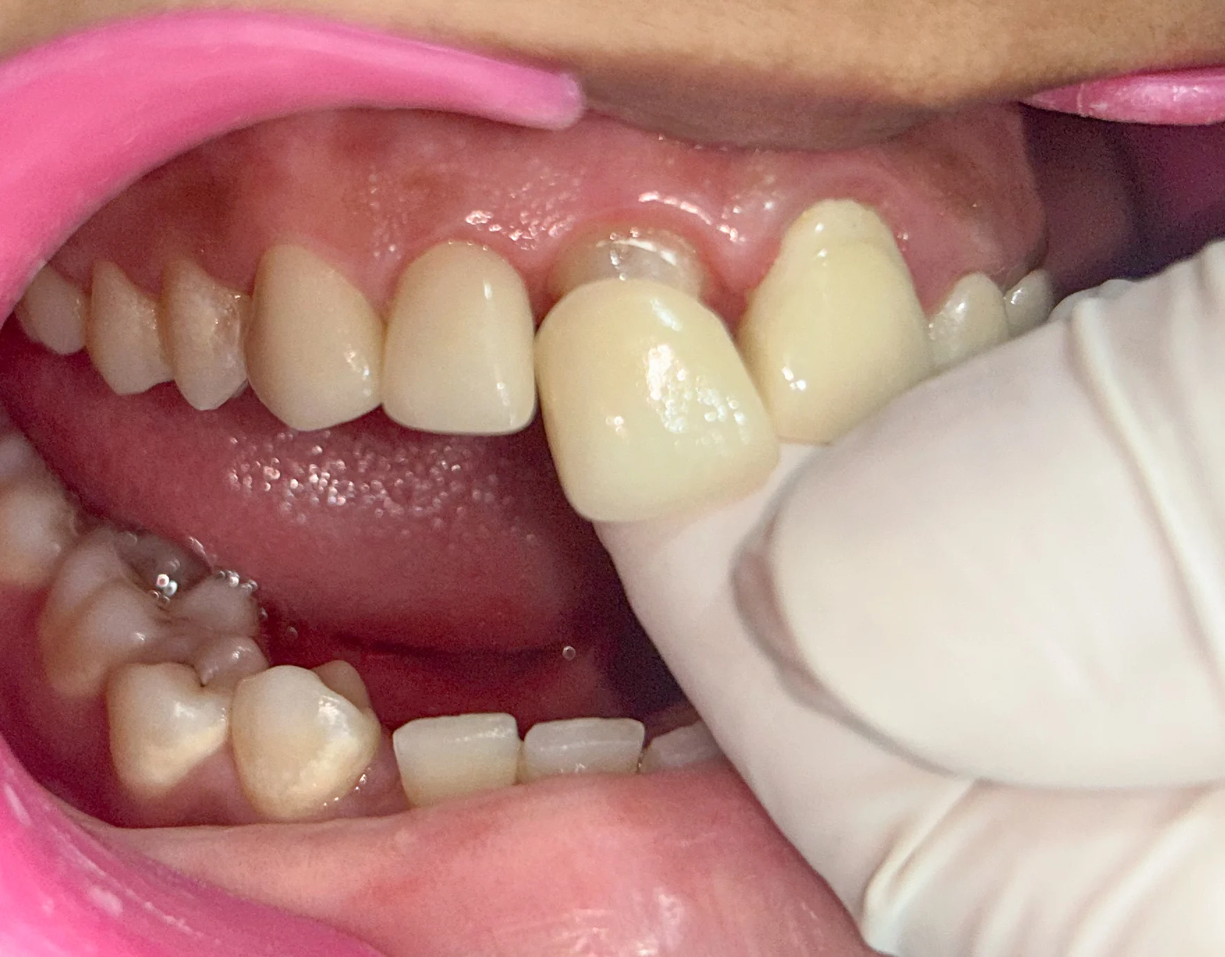 Tooth with dental crown treatment