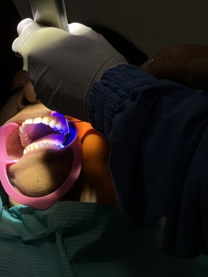 Tooth decay treatment showing deep cavities and dental cleaning procedure