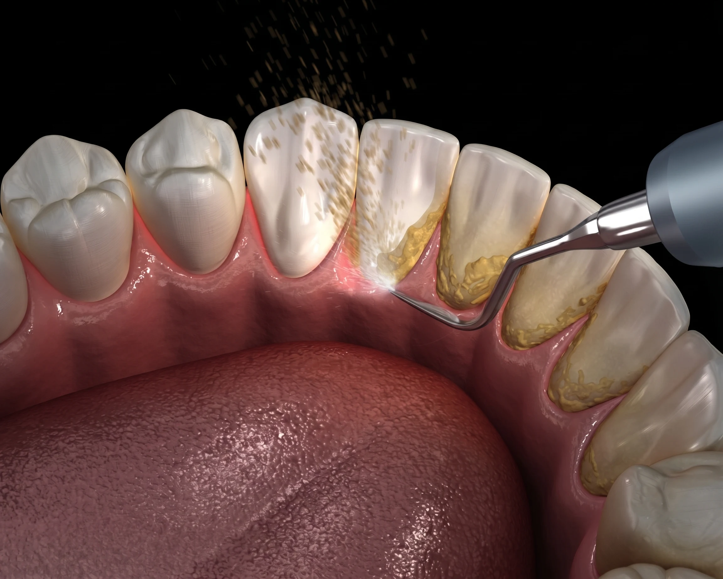Gentle Scaling and Tooth Polishings