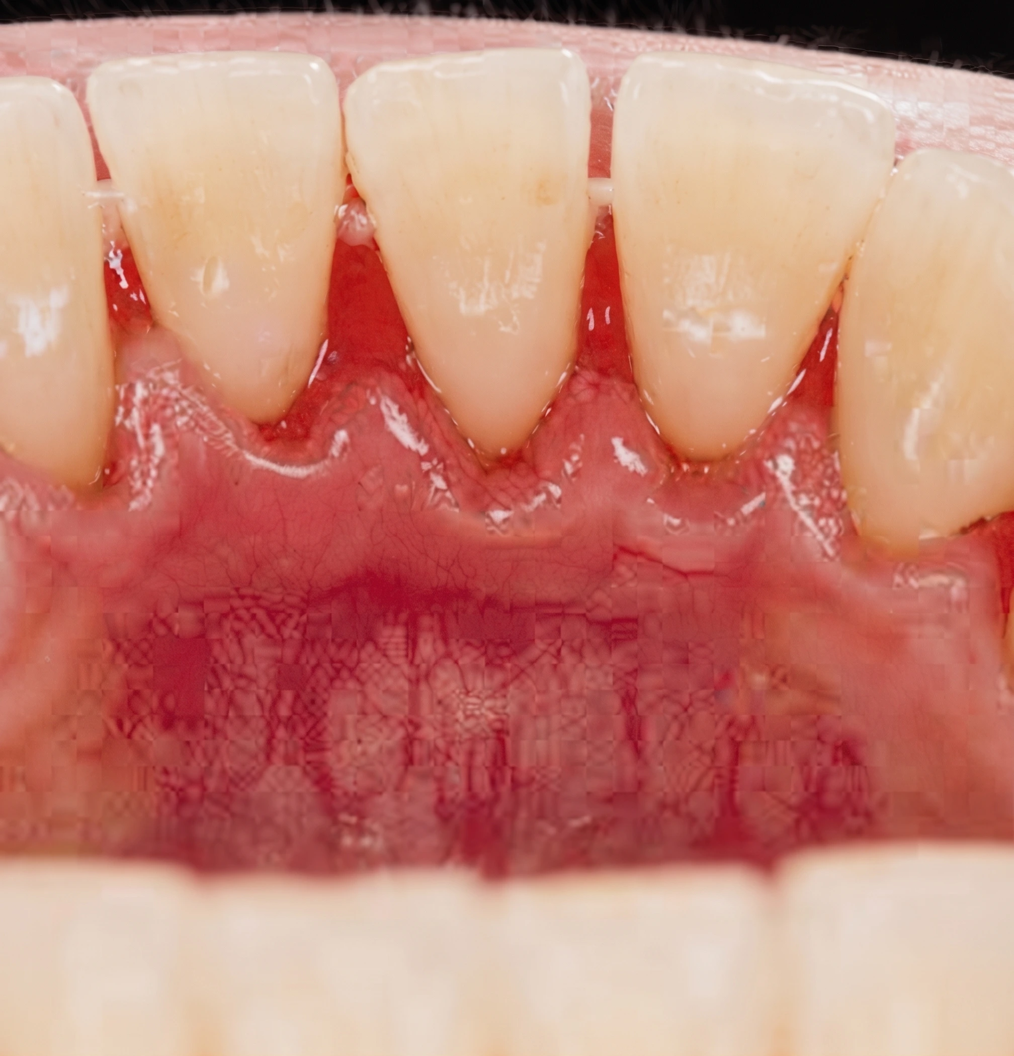 Scaling and Root Planing for Healthier Gums