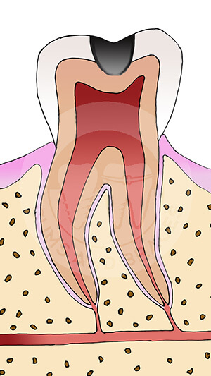 WM 2 caries in dentin