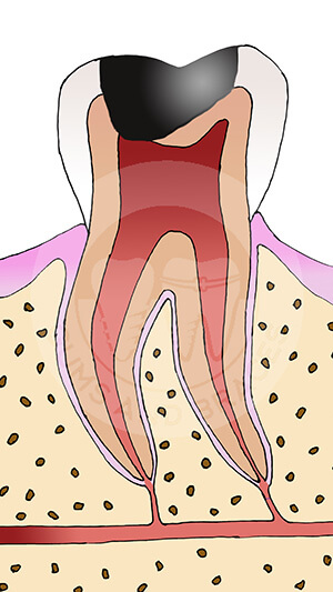 WM 3 caries involving pulp