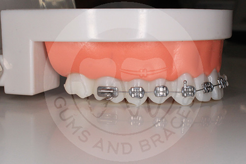 WM Metal Braces