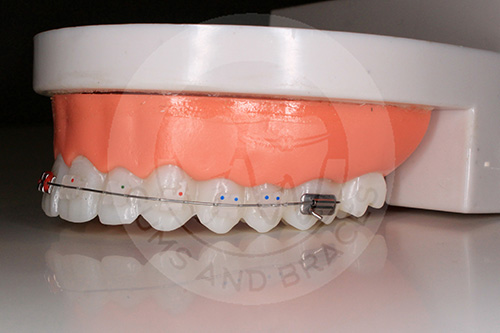 WM ceramic braces