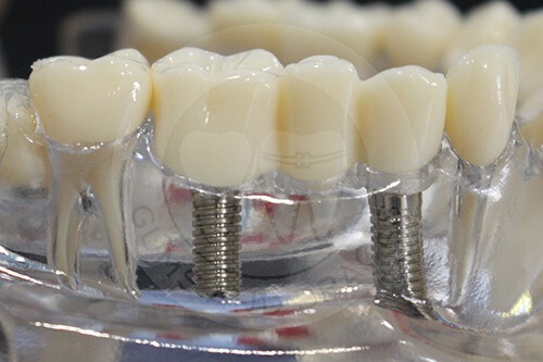 WM implant supported bridge