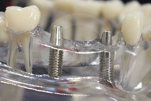 WM implants