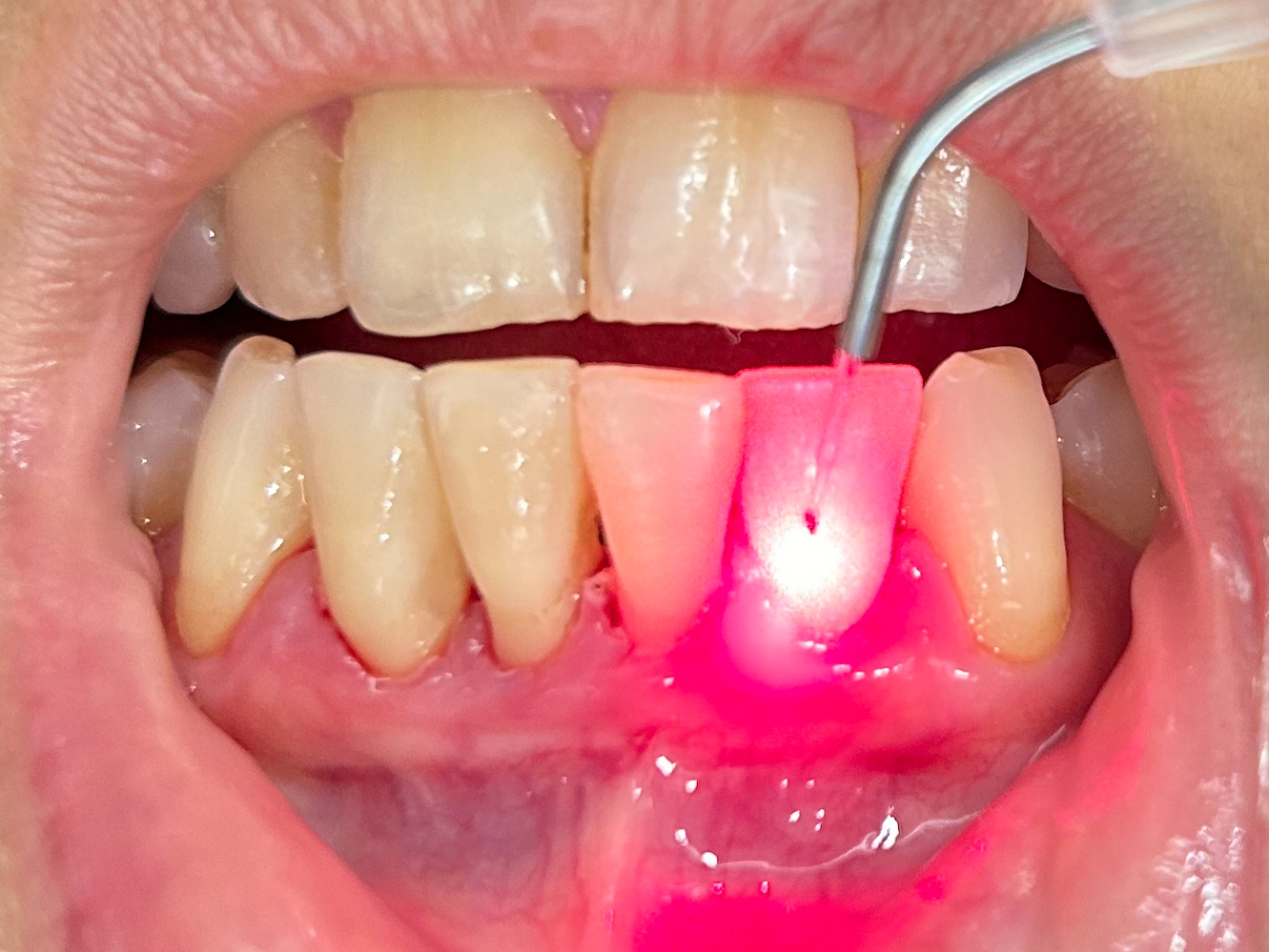 Gum Disease