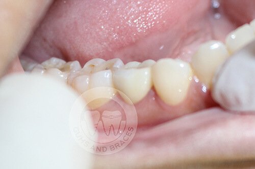 Crown Cemented