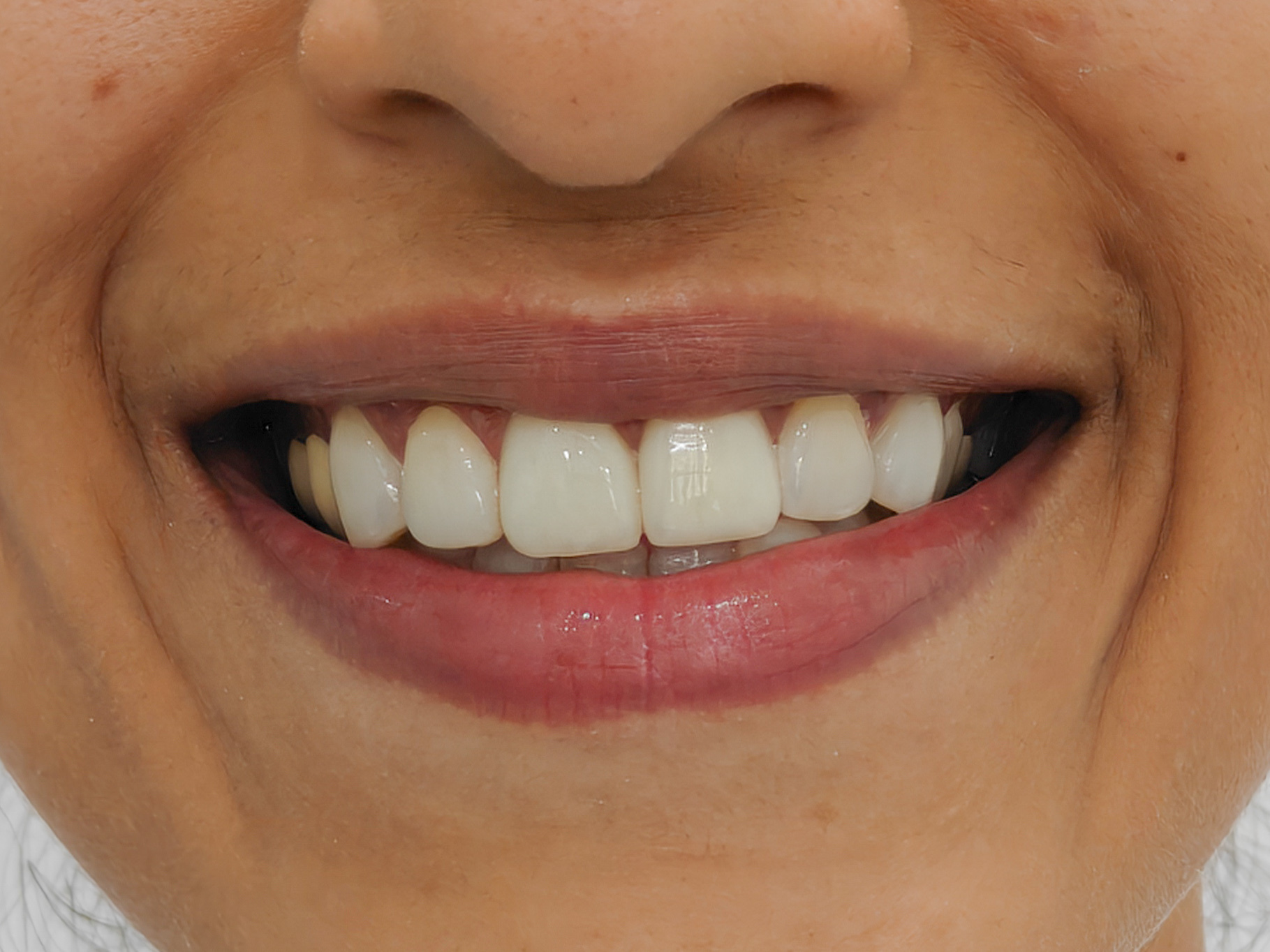Refresh Your Smile with Premium Dental Veneers