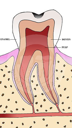 WM-1 caries in enamel
