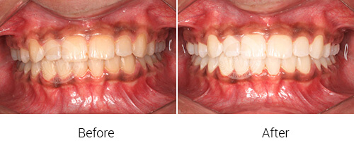 WM Bleaching