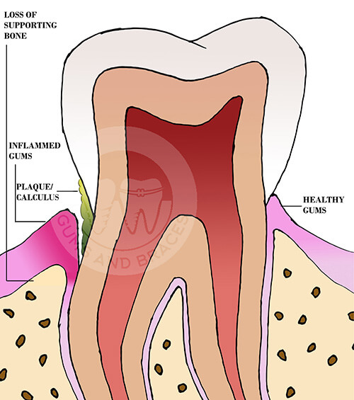 WM Periodontitis