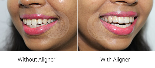 WM clear aligner