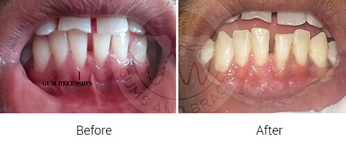 WM gum recession