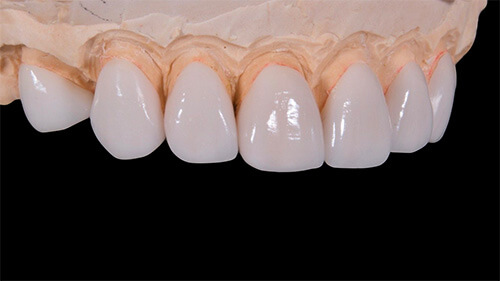 veneer